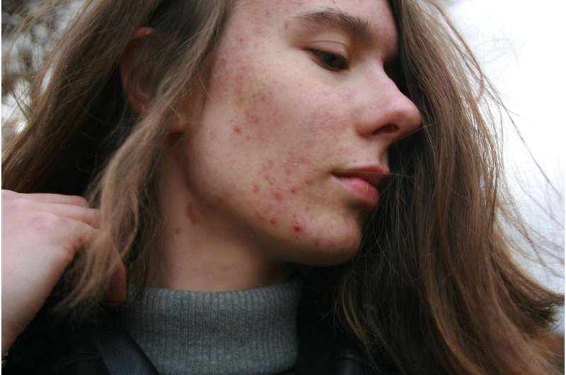 acne