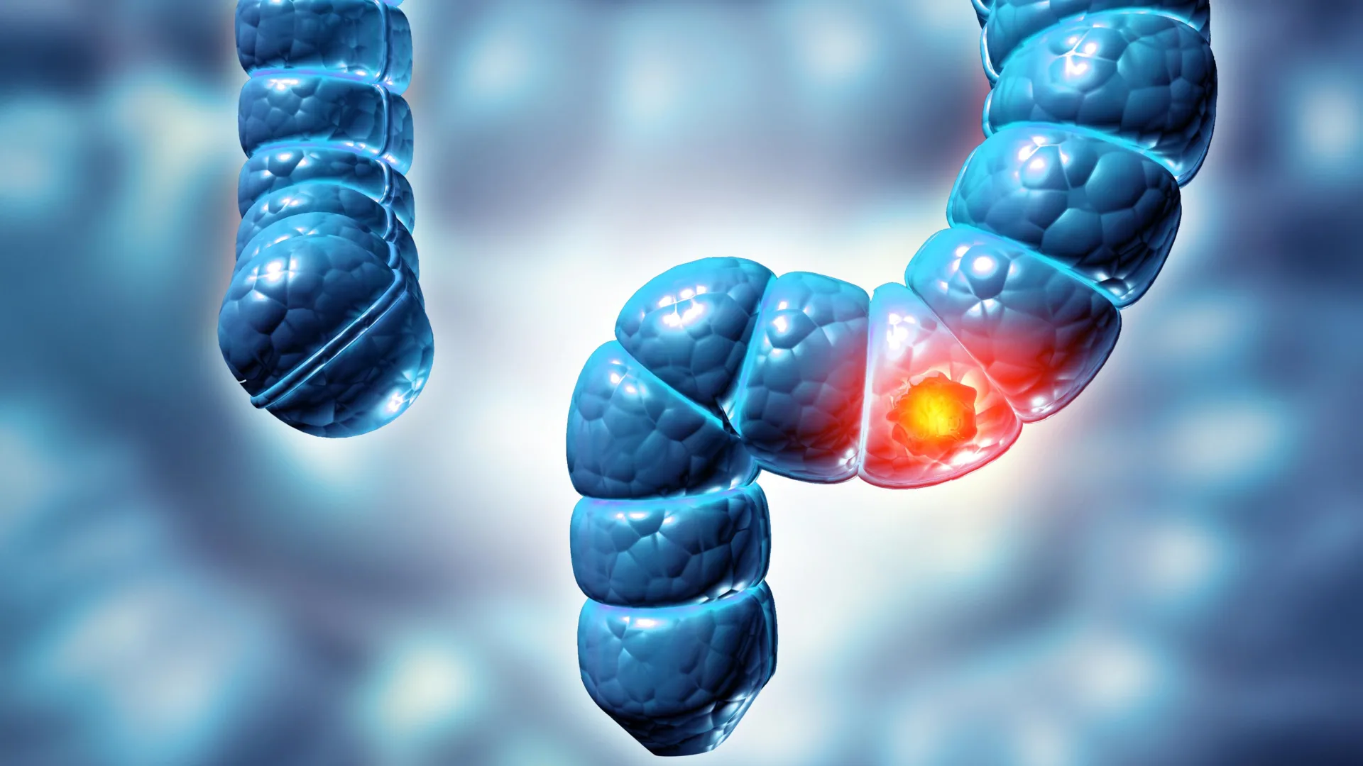 Colorectal cancer cells is climbing in young people and commonly found far too late