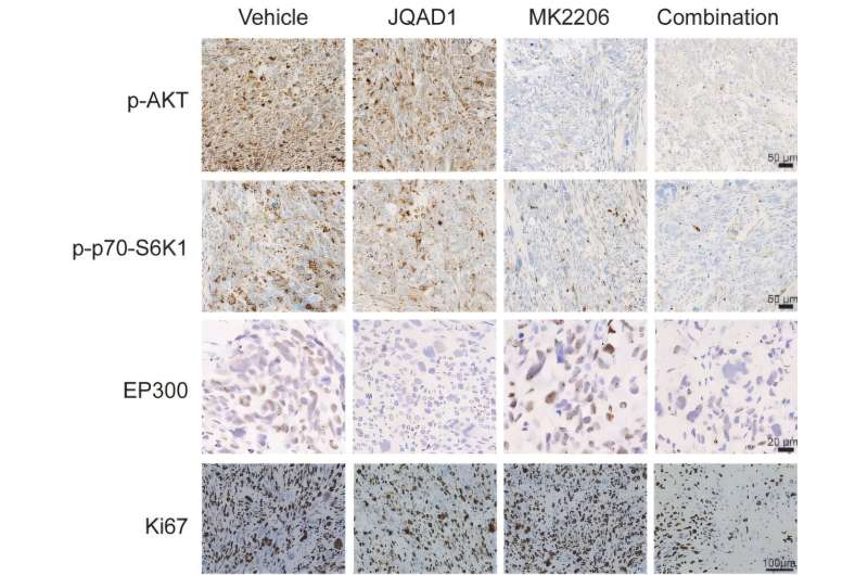 Combination therapy reveals potential vulnerability in aggressive osteosarcoma