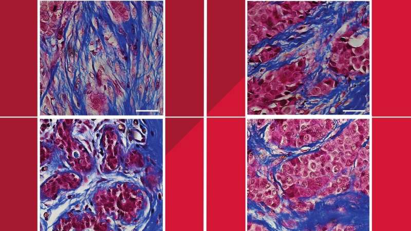 How socioeconomic factors affect outcomes in this deadly cancer