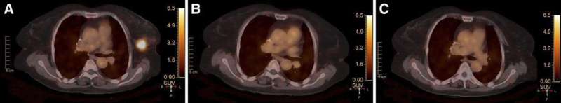 Molecular imaging demonstrates promise for predicting complete pathologic response in HER2-positive breast cancer