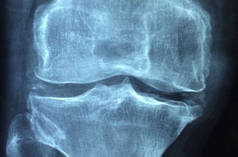 Credit: Pixabay/CC0 Public Domain osteoporosis