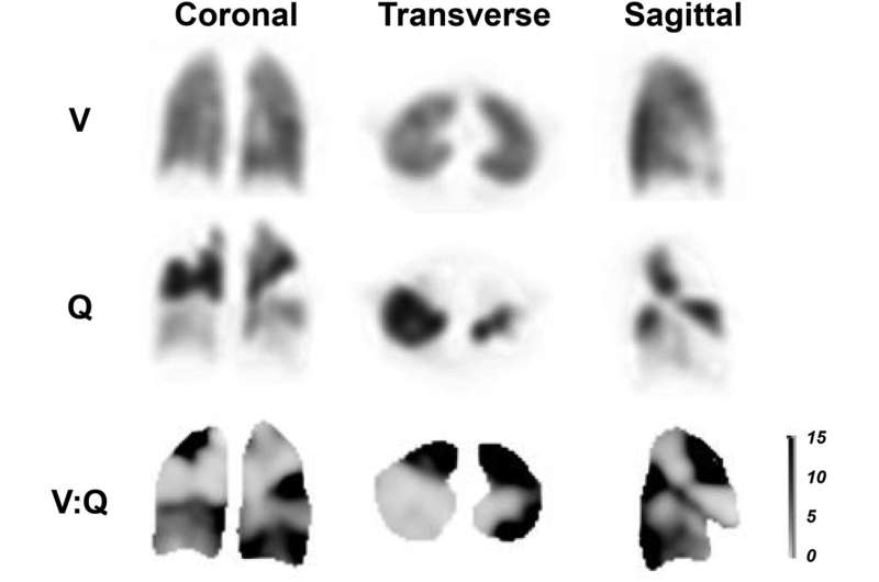 Procedure standard/procedure guideline for ventilation–perfusion pulmonary scintigraphy published