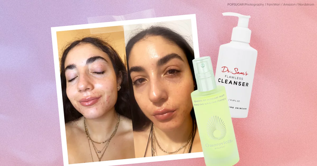 Keeping Acne Skin Hydrated on Accutane: An Expert Weighs In